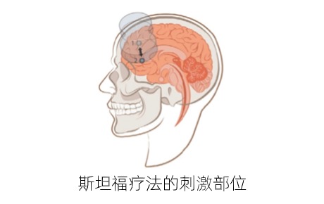 高质量文献：多疗程斯坦福疗法（snt）对重度抑郁症复发后疗效验证